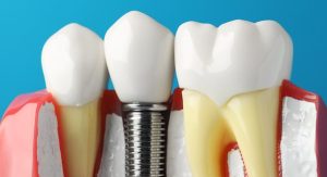 dental implant
