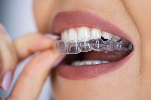 Invisalign clear aligners