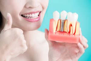 dental implants