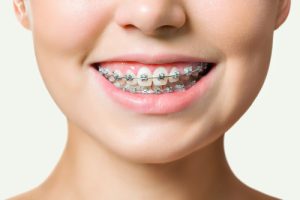 woman smiling with braces 