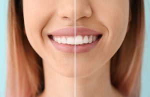 before and after gum contouring