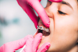 Orthodontist,Checking,Girls,Dental,Braces