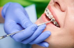 Close,Up,Of,Dentist,Hand,Using,Dental,Forceps,While,Putting