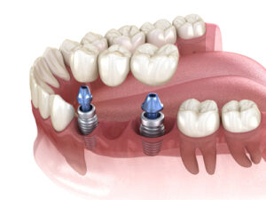 Dental,Bridge,Supported,By,Implants.,Medically,Accurate,3d,Illustration